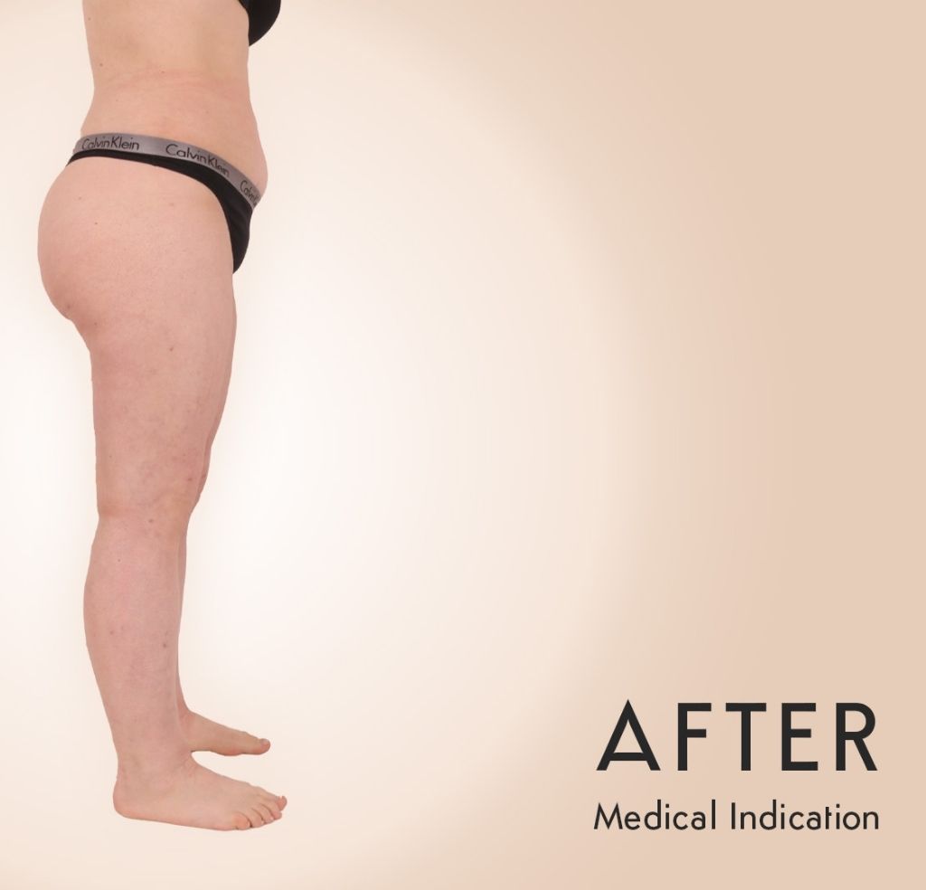 Lipedema Patient Michel Aesthetics Dubai - after
