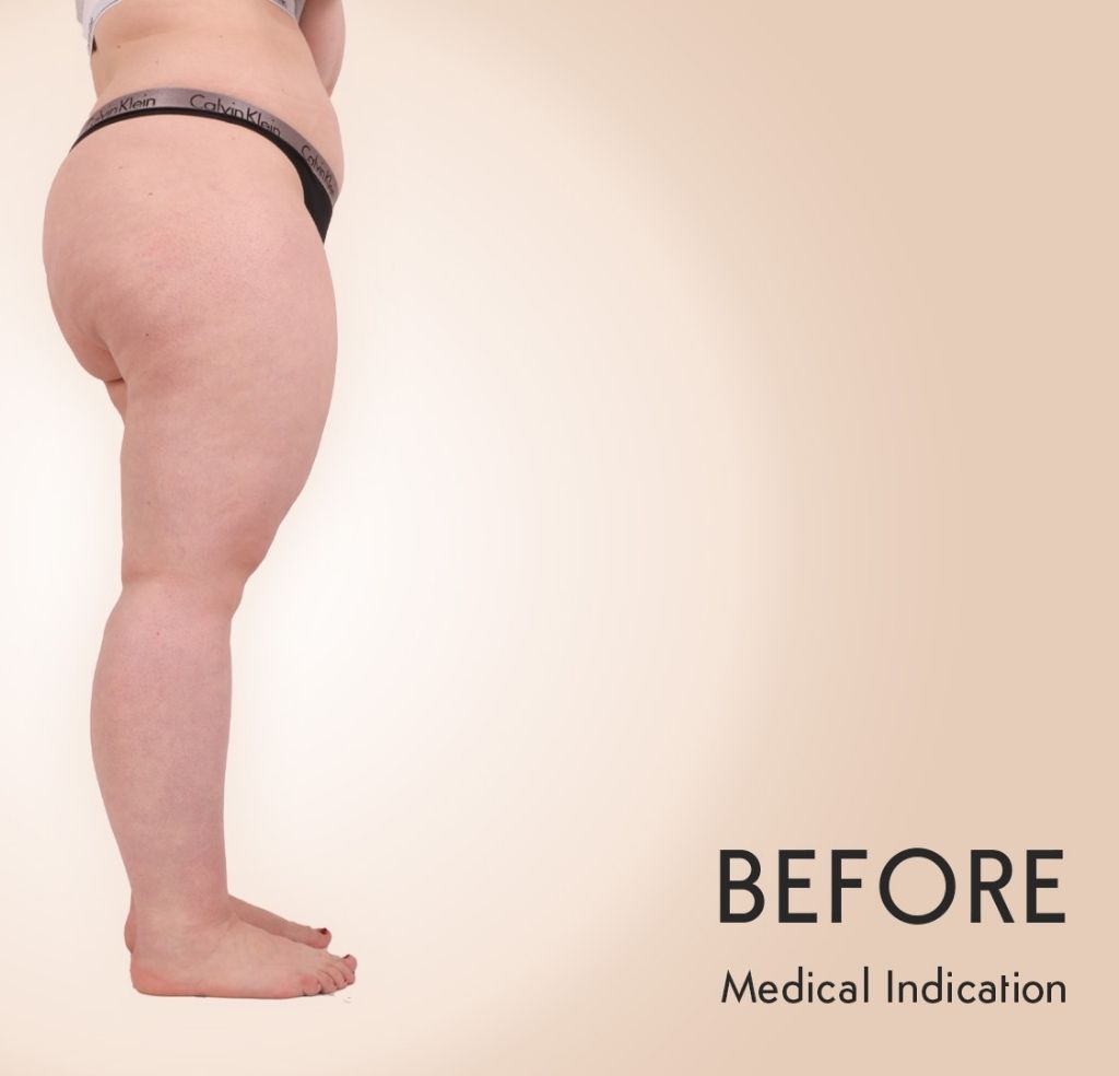 Lipedema Patient Michel Aesthetics Dubai - before