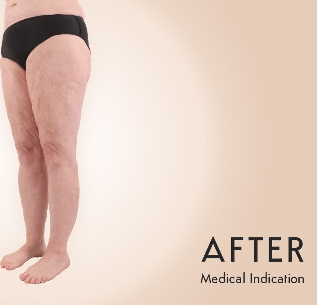 Lipedema Patient Michel Aesthetics - after