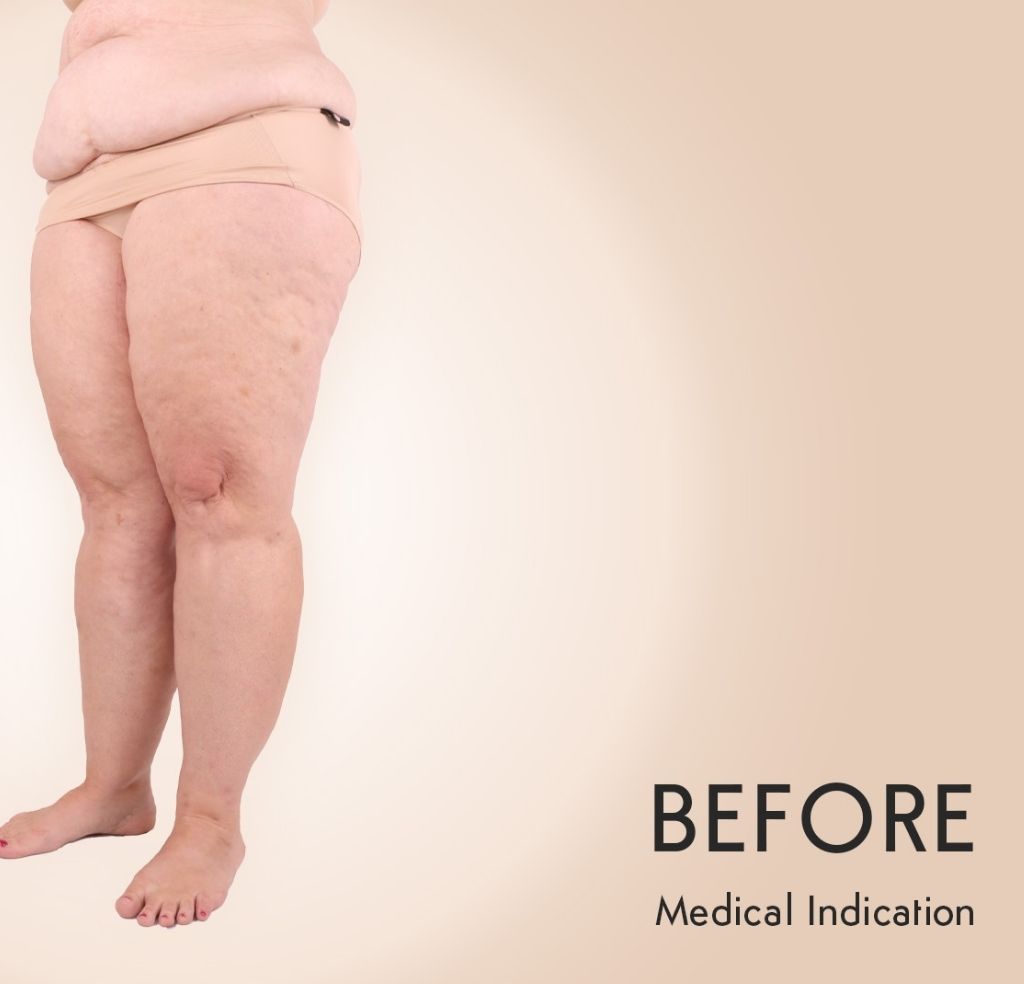 Lipedema Patient Michel Aesthetics - before