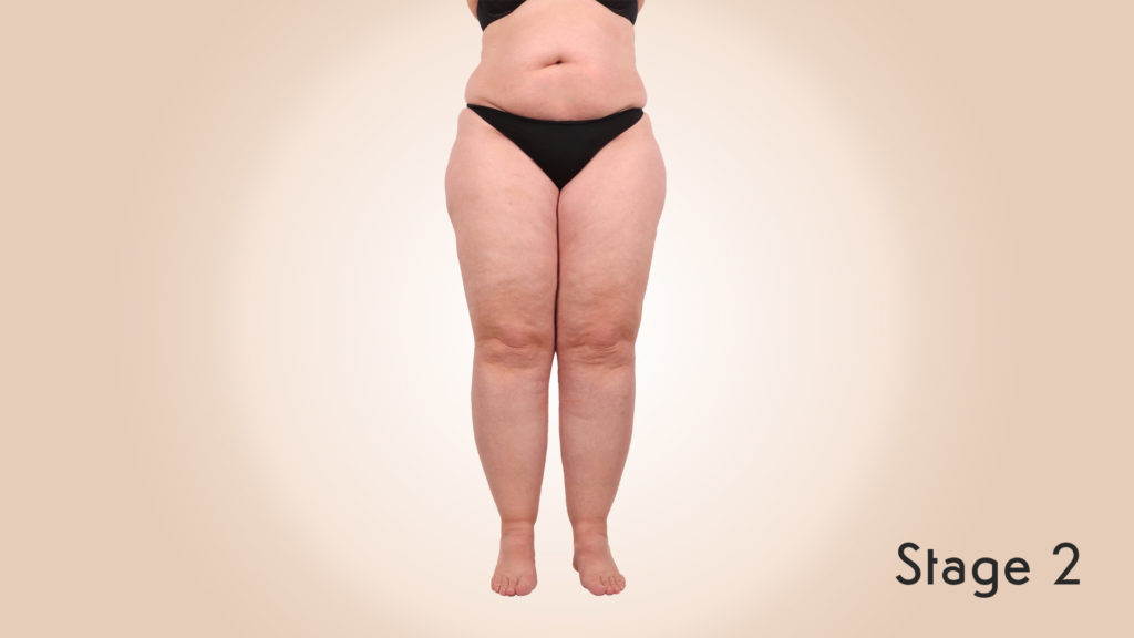 Lipedema Stage 2