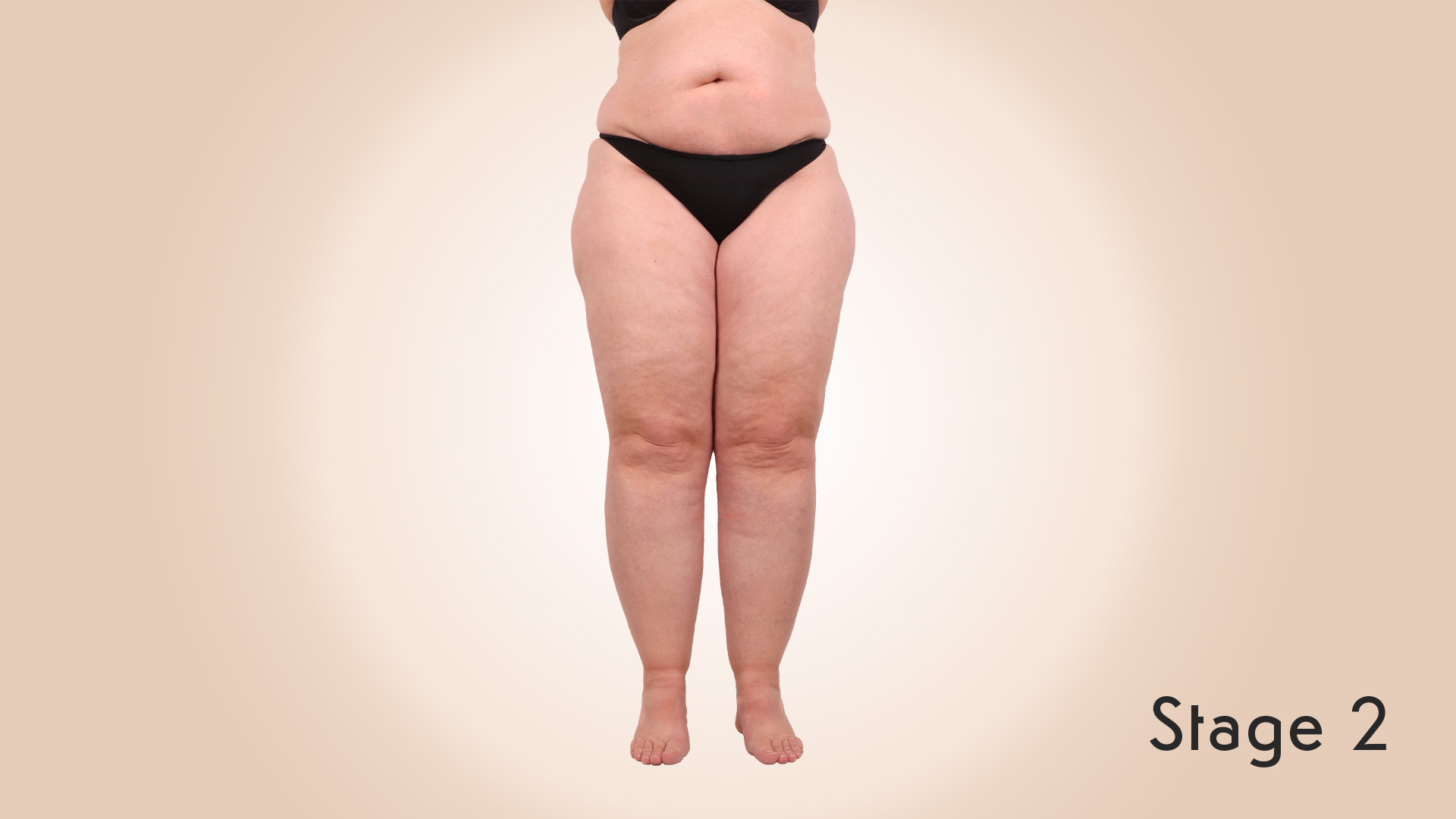 Lipedema Stage 2