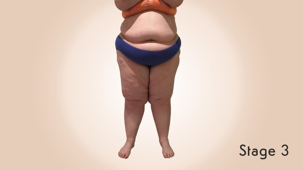 Lipedema Stage 3