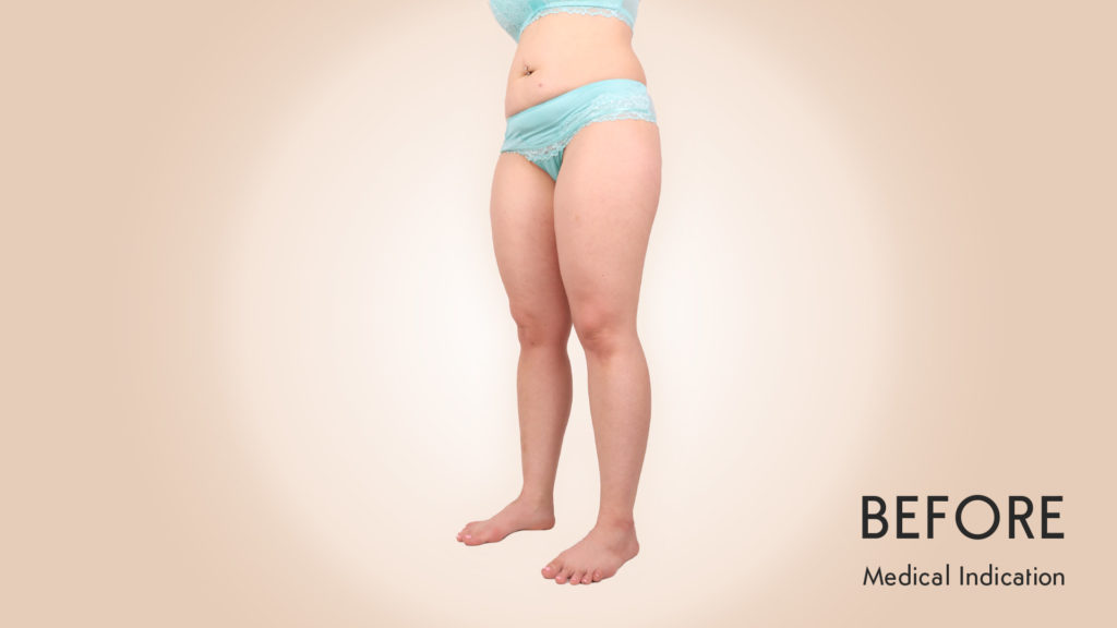 Patient Lipedema before 1