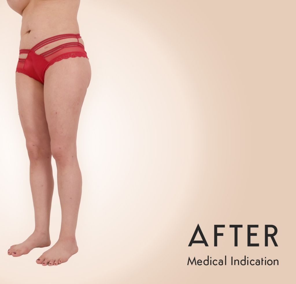 Sebastian Michel - Lipedema after