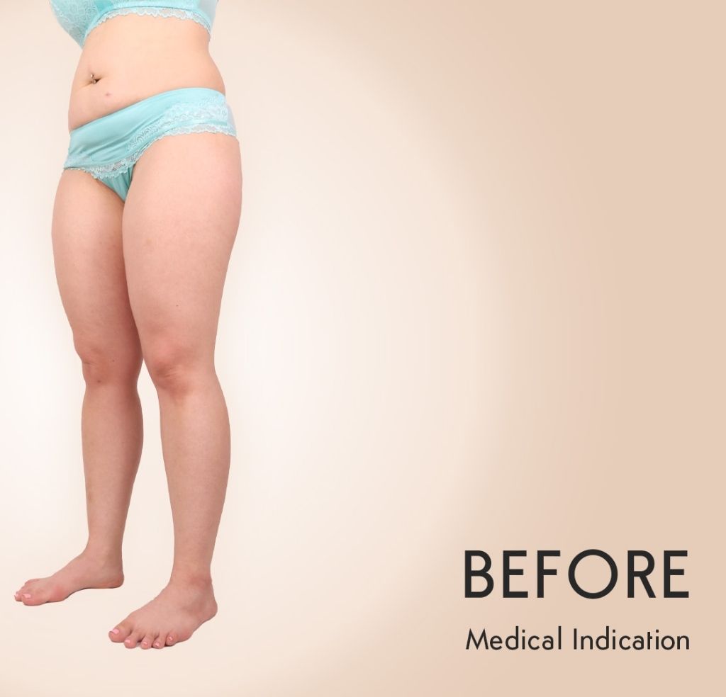 Sebastian Michel - Lipedema before