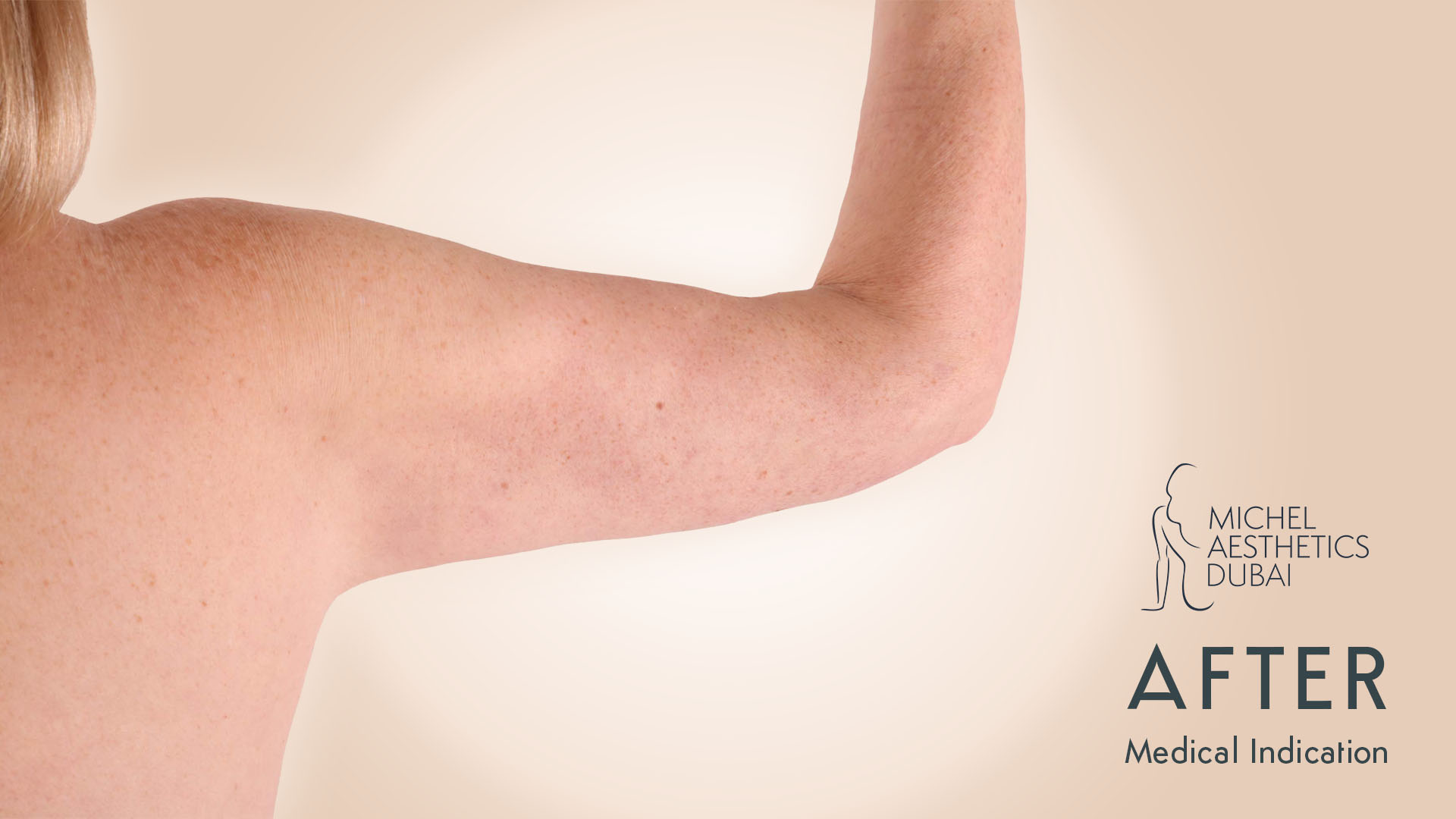 Arm lift after
