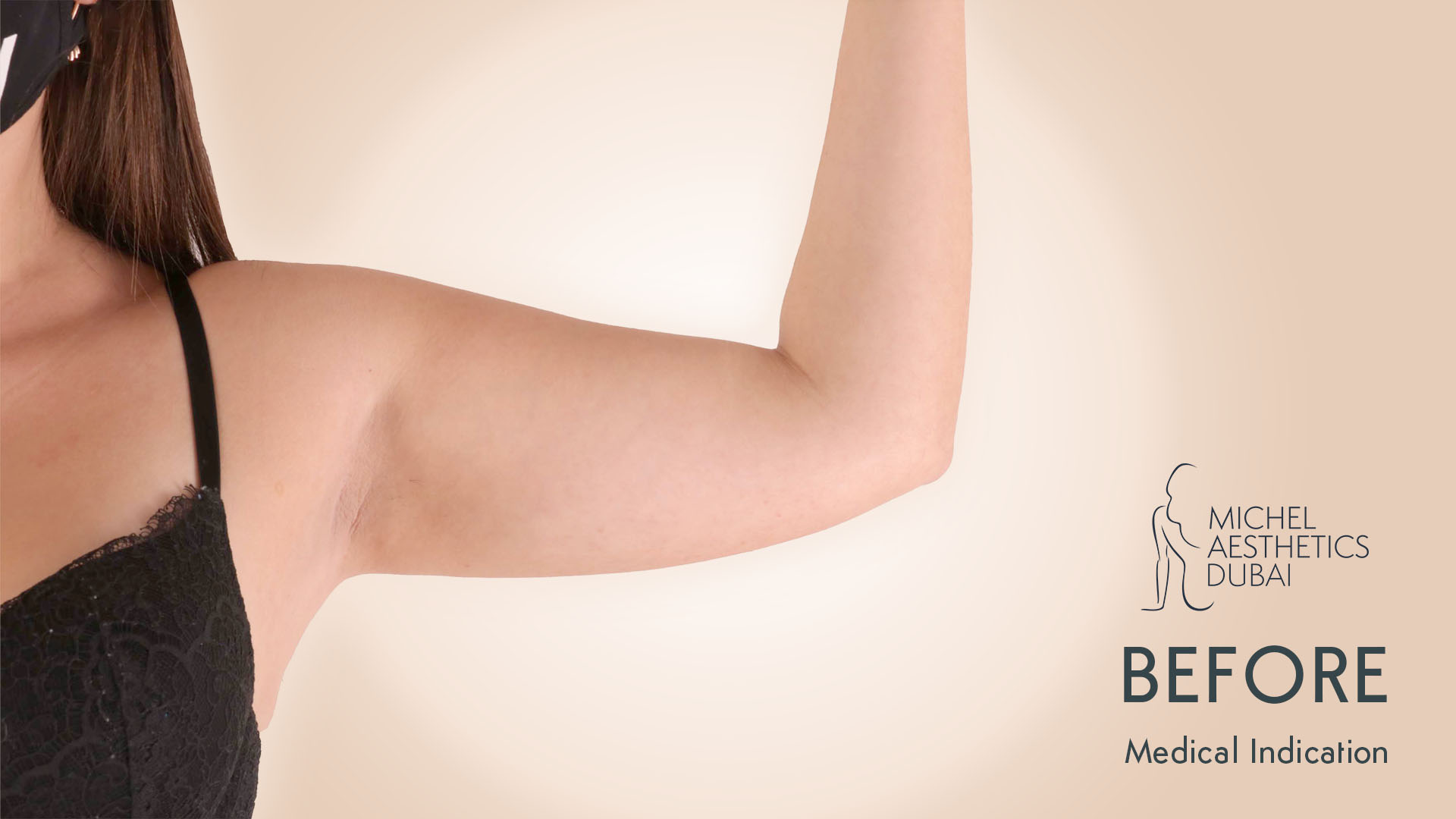 Arm lifting - Michel Aesthetics before