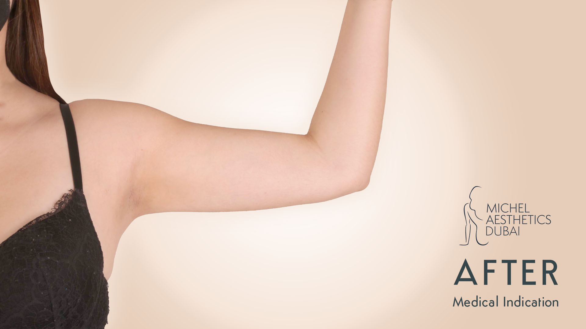 Arm lifting after