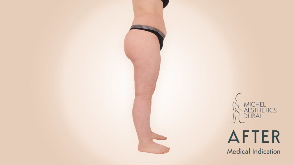 Lipedema Patient Michel Aesthetics Dubai - after