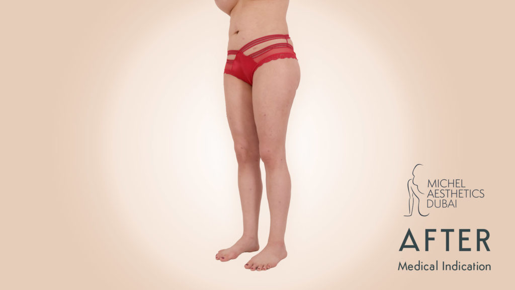 Sebastian Michel - Lipedema after