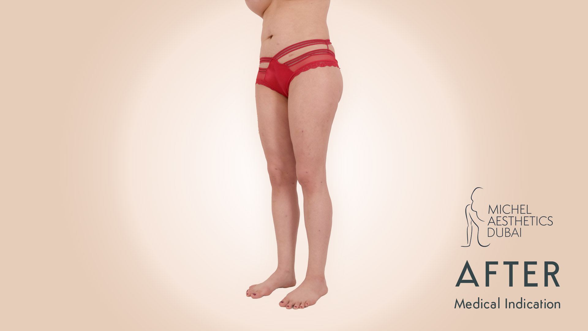Sebastian Michel - Lipedema after