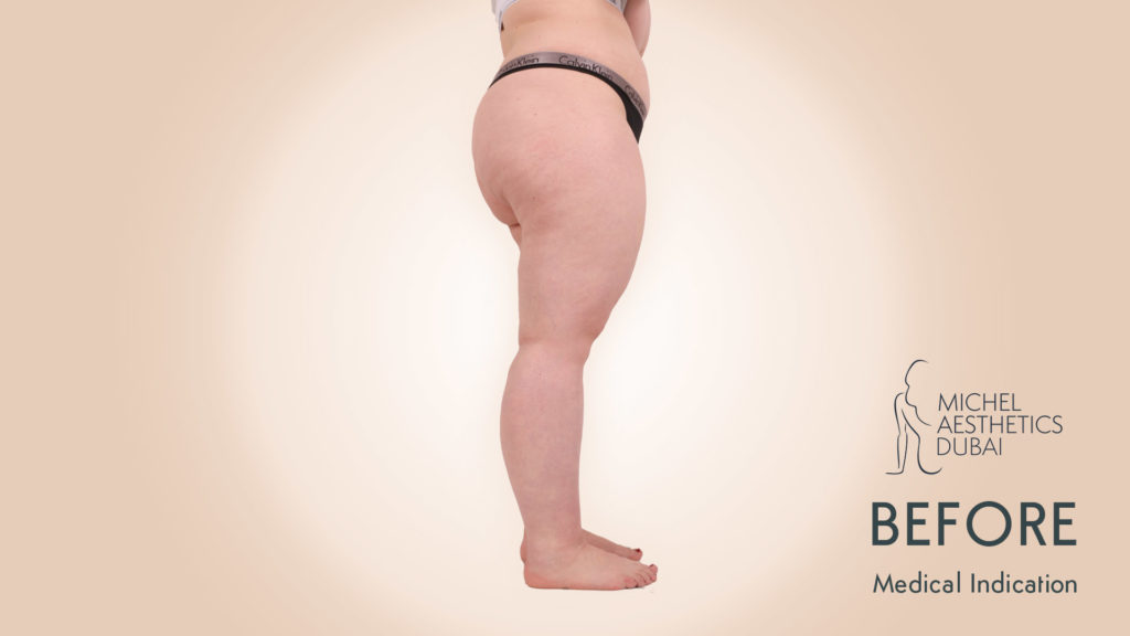 Lipedema Patient Michel Aesthetics Dubai - before