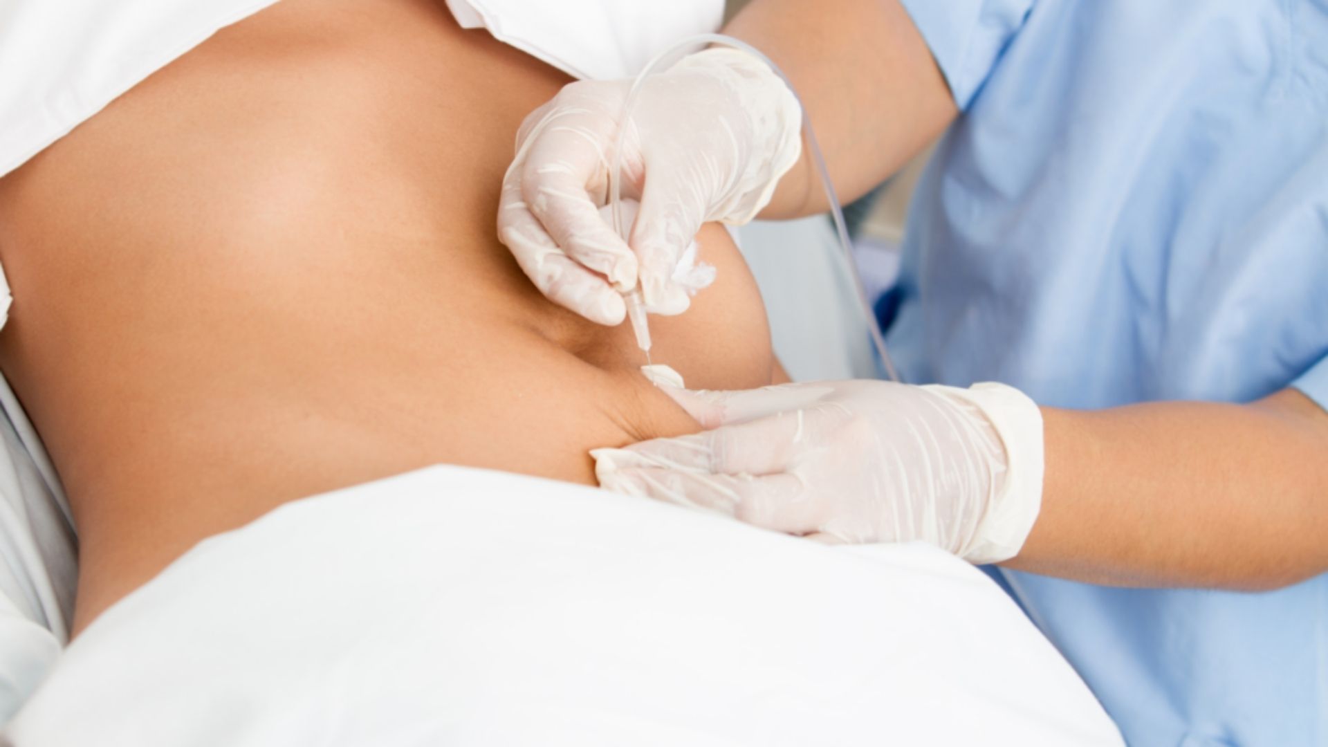 Surgical Lifting - Michel Aesthetics