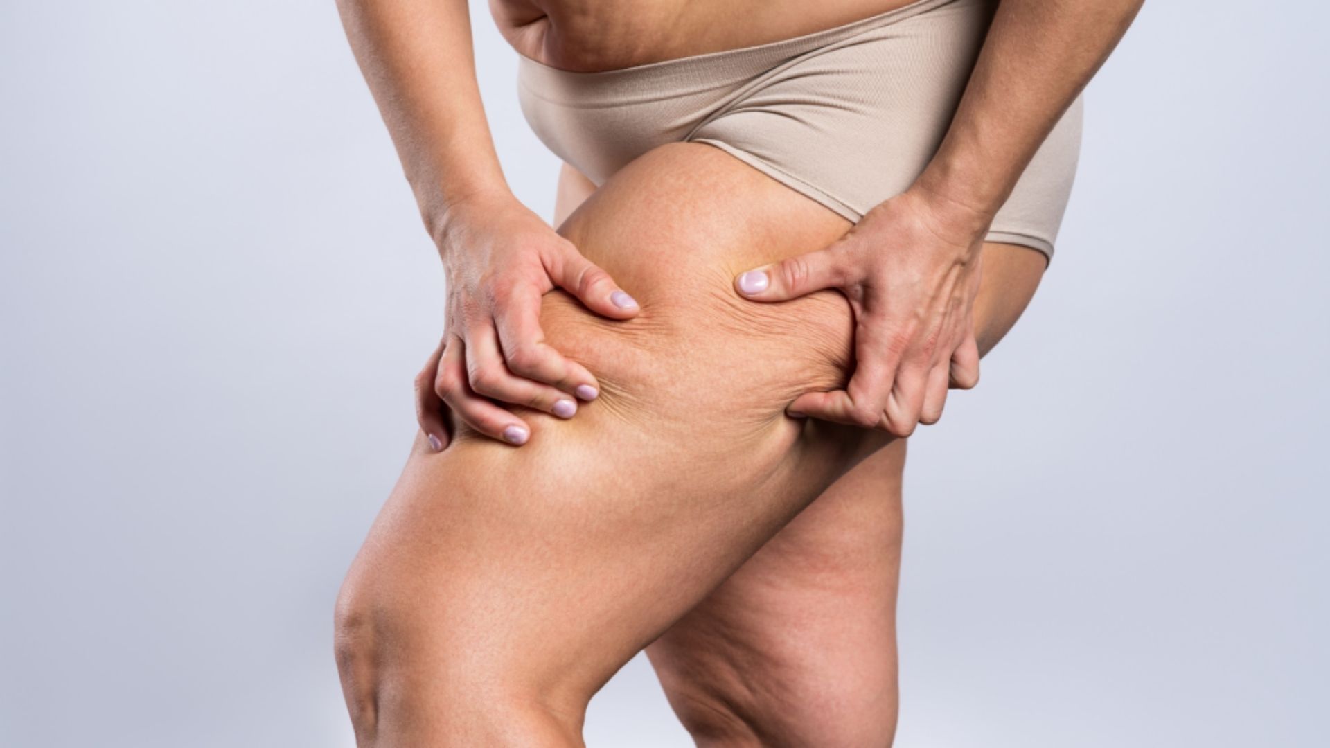 Lipedema Sebastian Michel