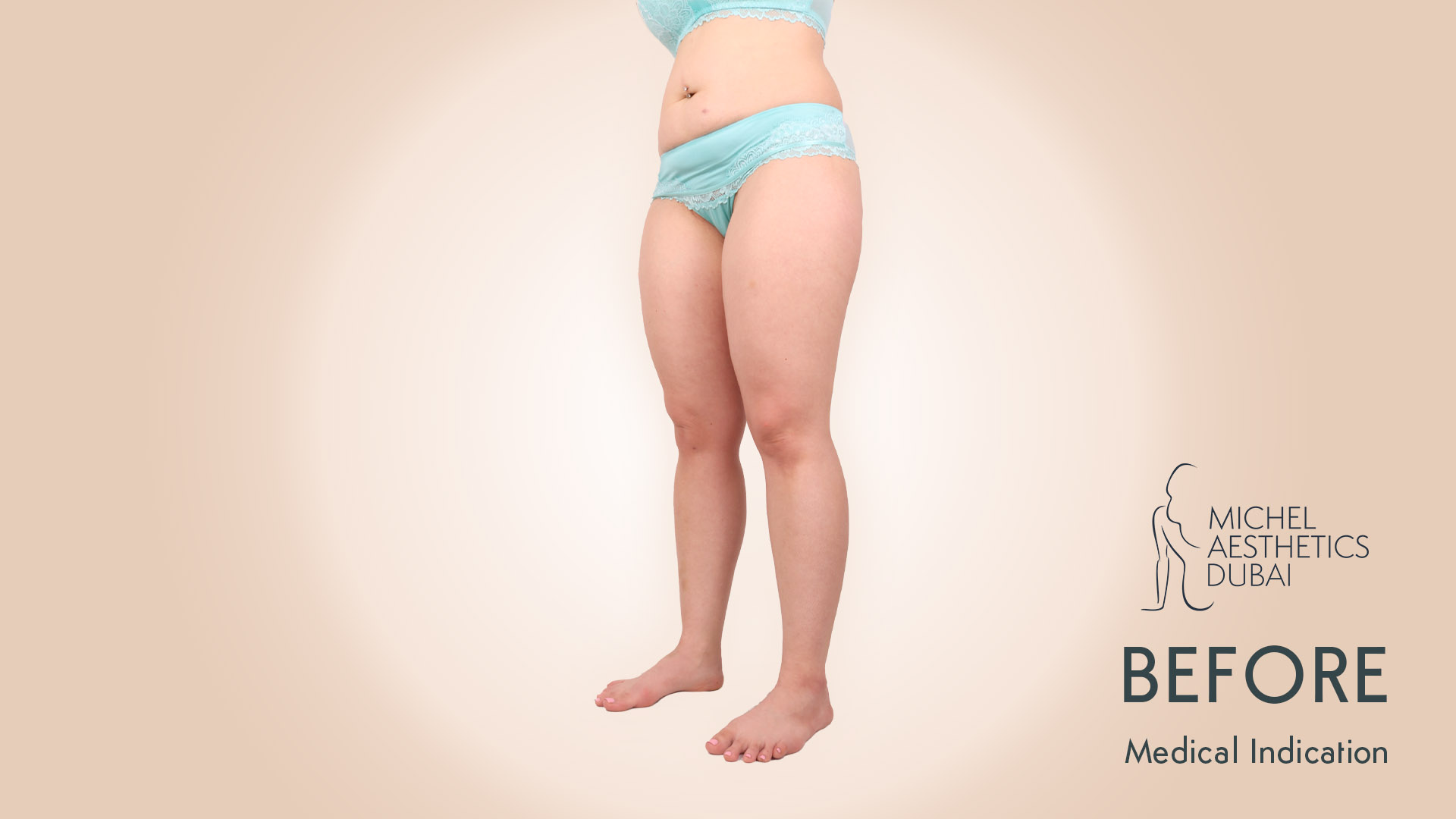 Sebastian Michel - Lipedema before