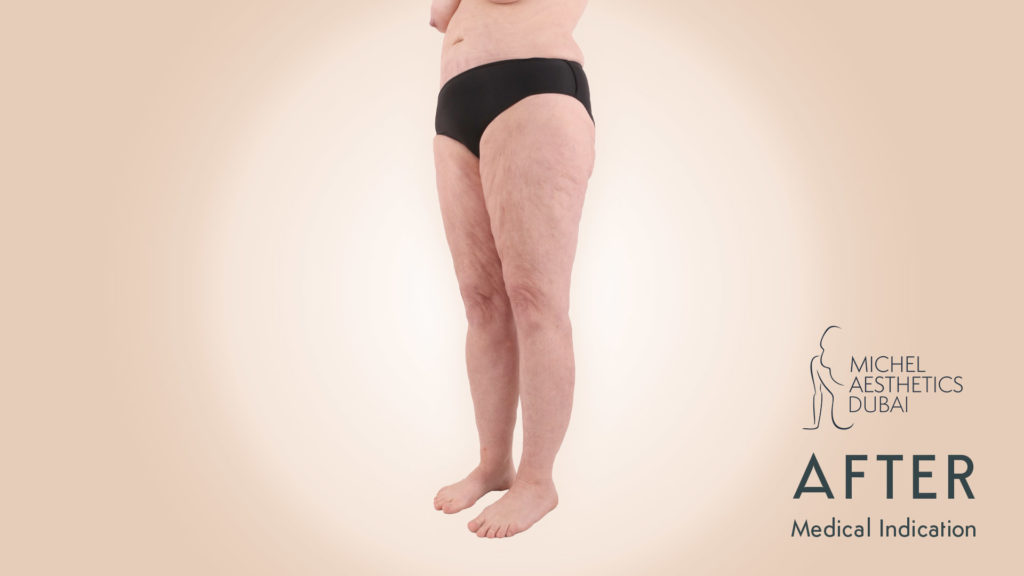 Lipedema Patient Michel Aesthetics - after