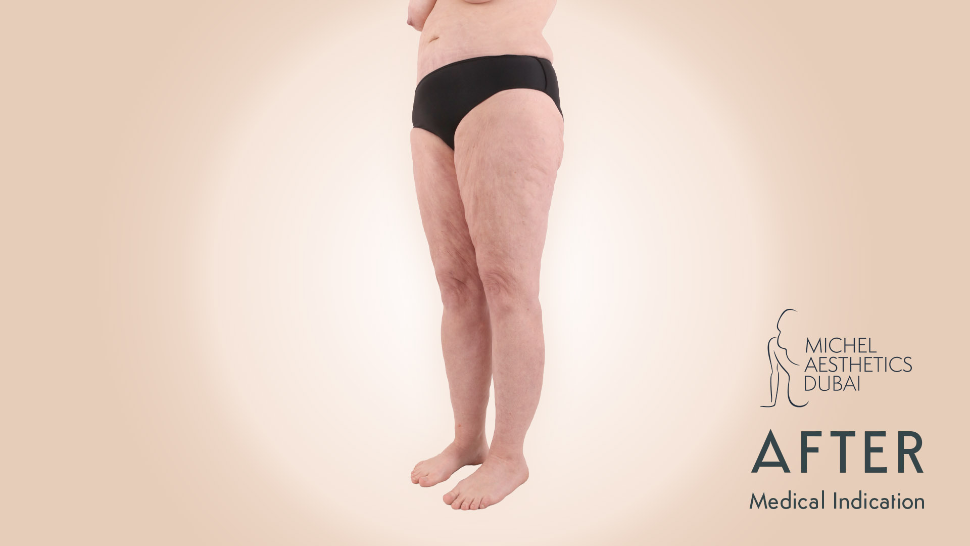 Lipedema Patient Michel Aesthetics - after