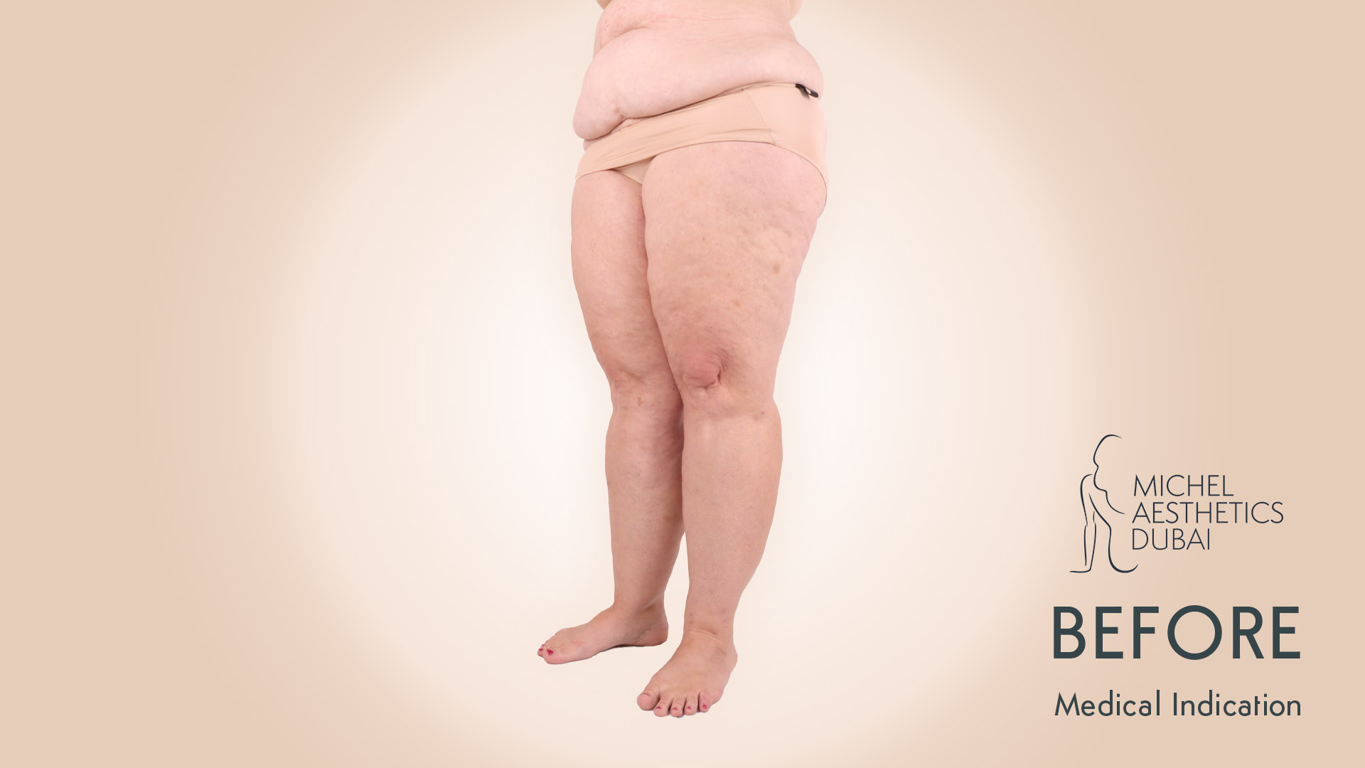 Lipedema Patient Michel Aesthetics - before